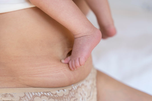 How to Get Rid of Pregnancy Stretch Marks